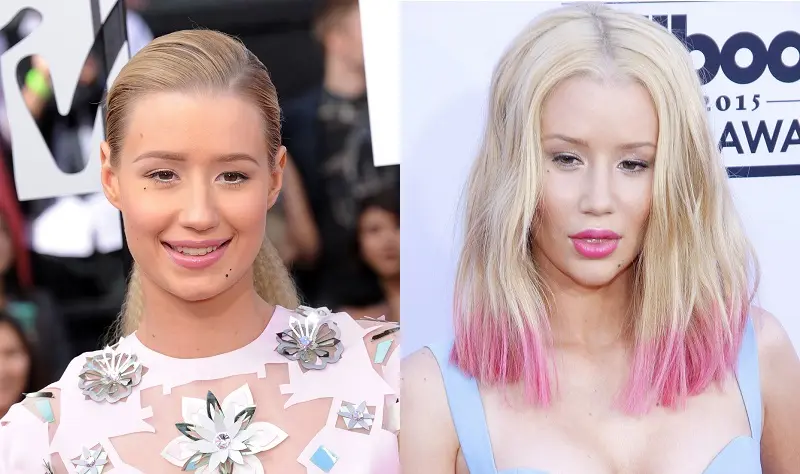 Iggy Azalea Nose Job