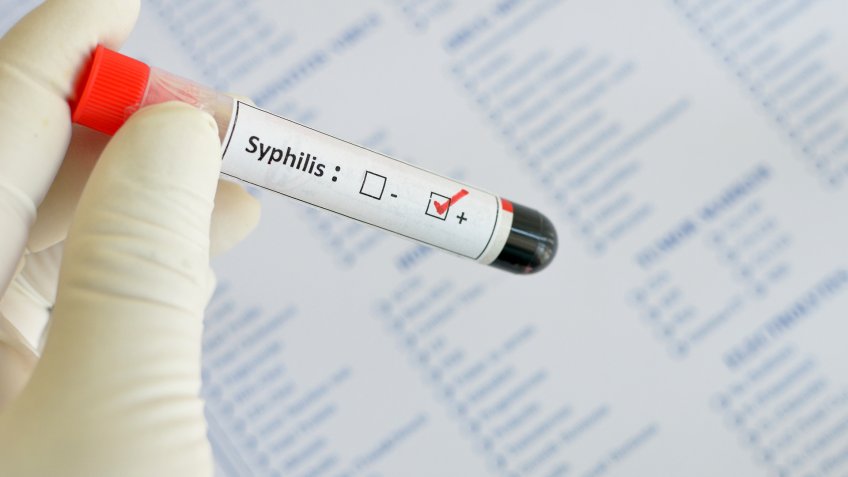 A blood sample with syphilis (Treponema Pallidum bacteria) positive.