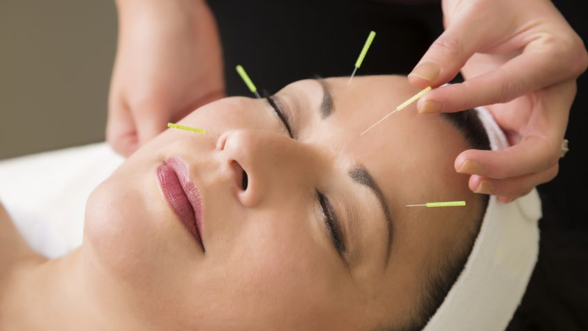acupuncture treatment