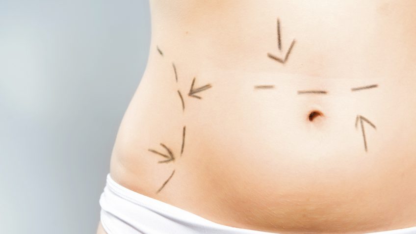 mommy makeover surgery