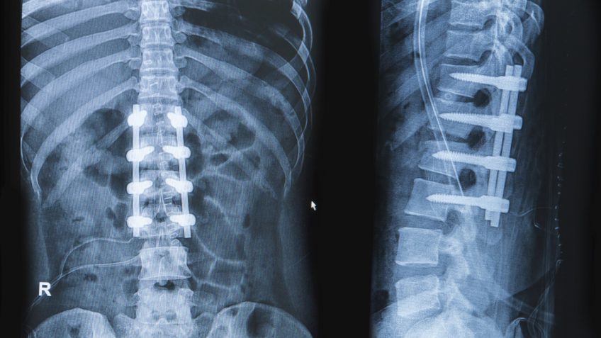 spinal fusion surgery