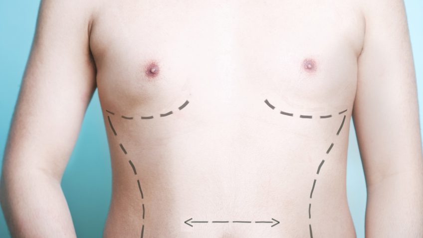 liposuction surgery