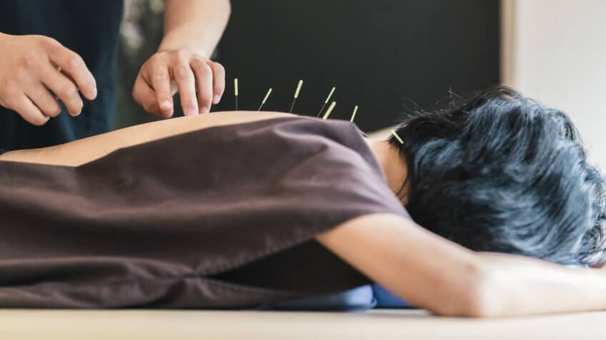 person getting acupuncture