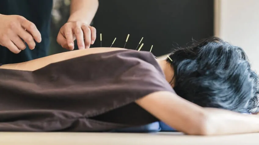 person getting acupuncture