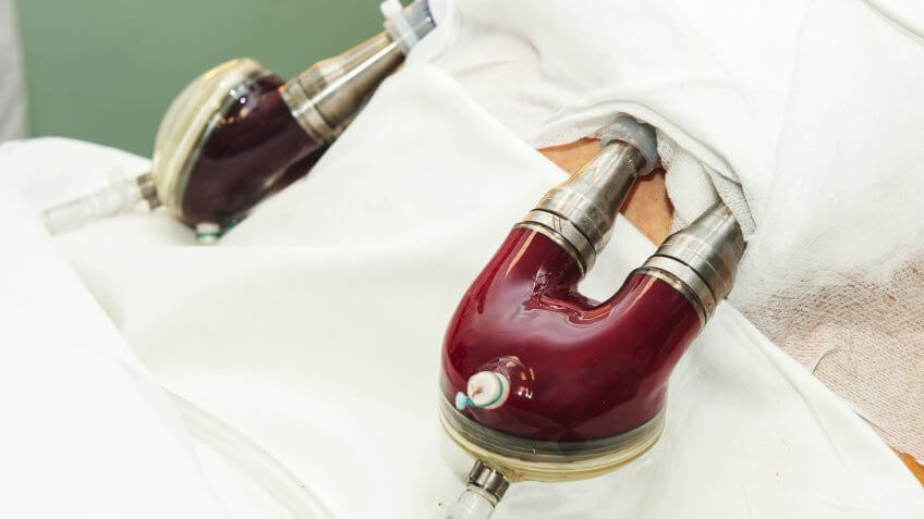 artificial heart