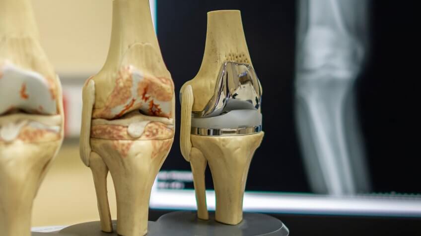 knee replacement technology