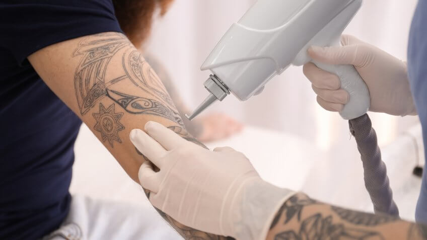man getting tattoo removed