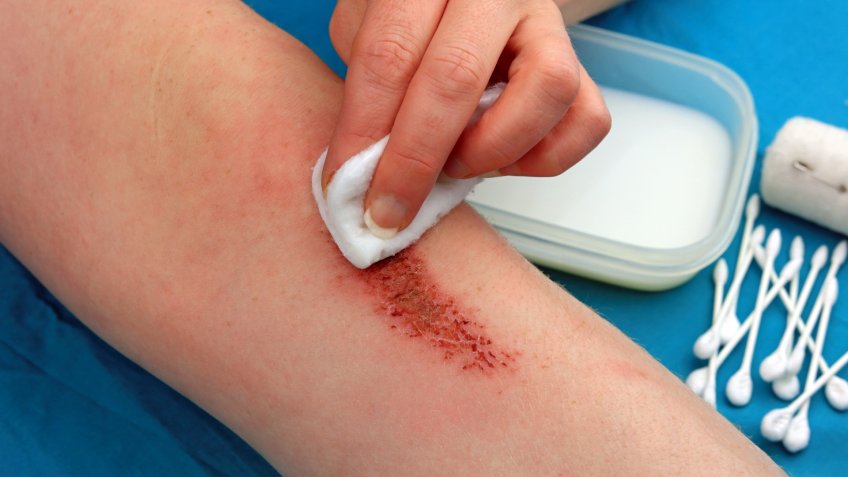 Cleaning Flesh Wound On A Leg With Antiseptic Liquid To Help Stop Infection.